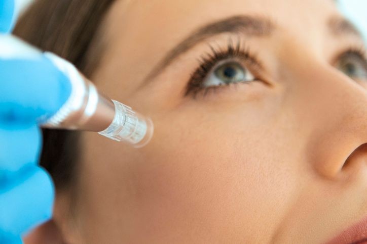 Microneedling o Microagujas