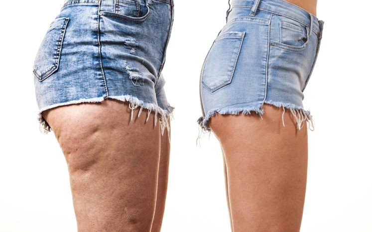 Como eliminar celulitis de los gluteos eficazmente