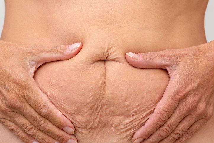 Tensado abdominal con Radiesse